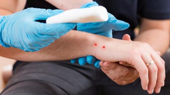 Secretaría de Salud en Sonora exhorta a prevenir mordeduras de serpiente