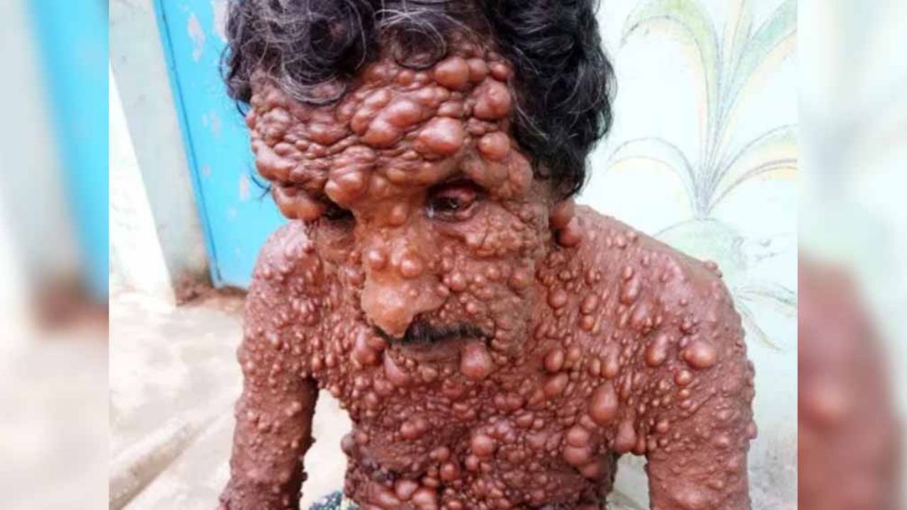 FUERTES IMÁGENES: La pesadilla de hombre cubierto de miles de tumores