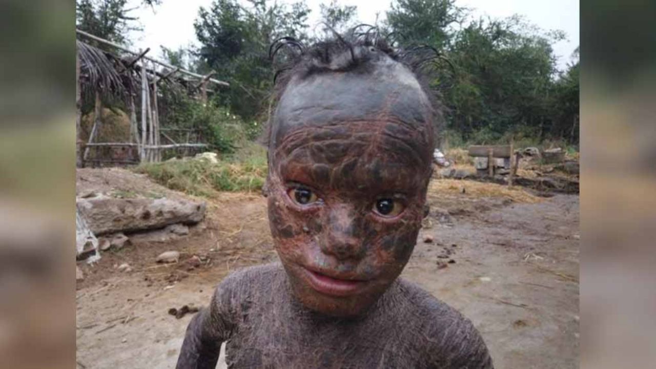 Insólito: El sufrimiento de un niño de 10 años con la incurable ‘piel de reptil’