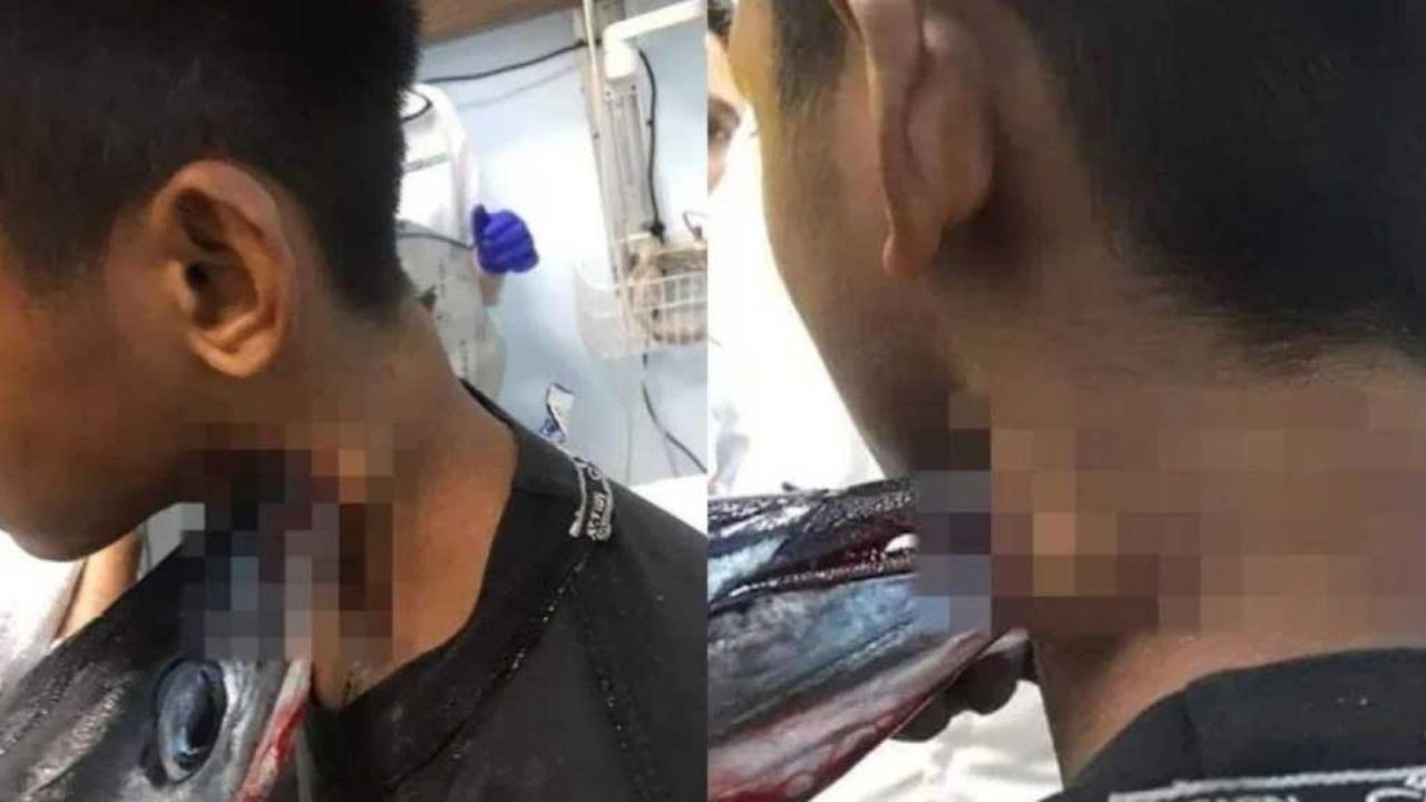 Joven indonesio requiere tres cirujanos para sacar pez espada de su cuello