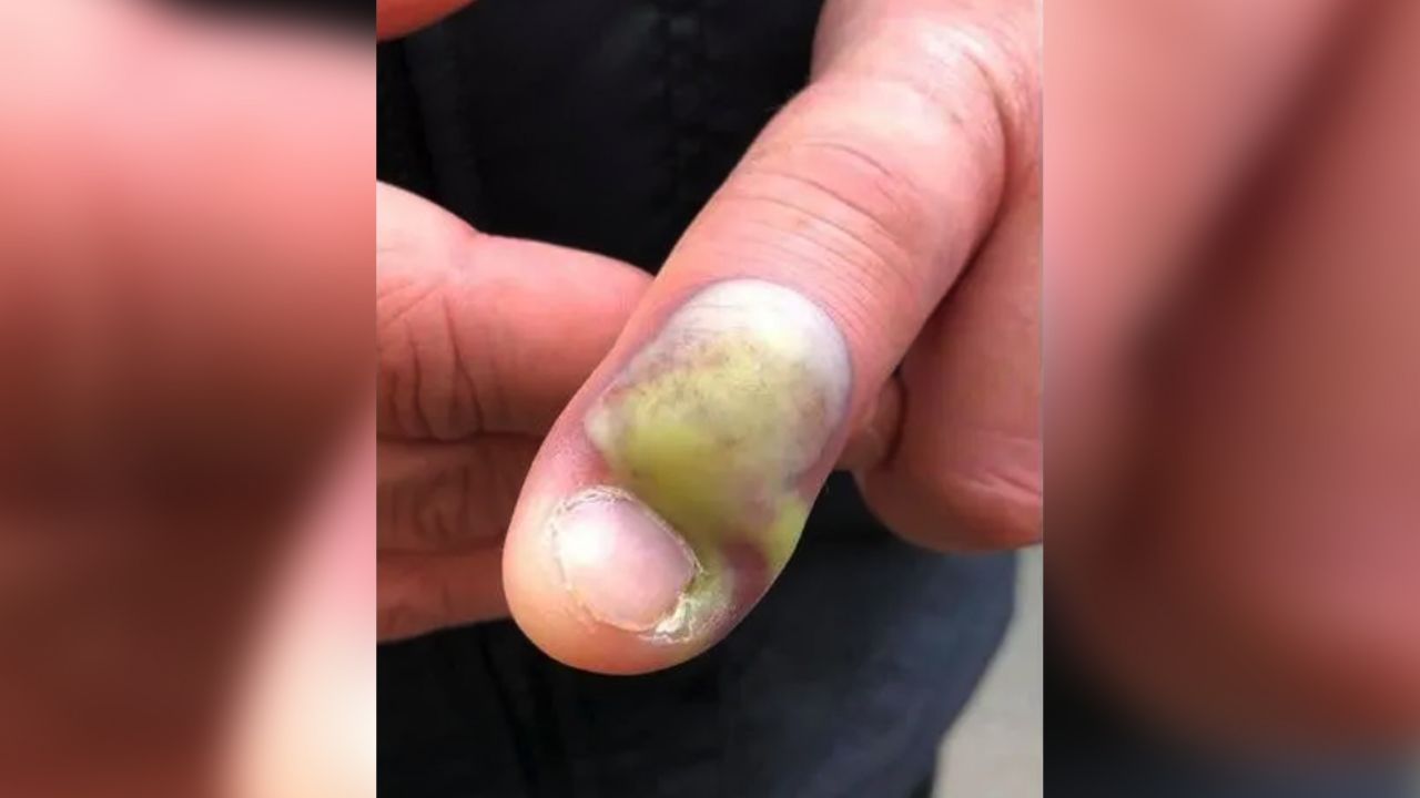 Hombre termina con fuerte infección en el dedo por comerse las uñas