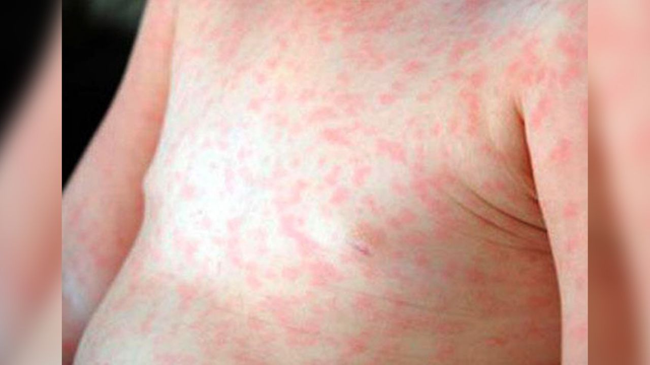 Bebé de 8 meses muere de sarampión; primera víctima de Brasil en 20 años