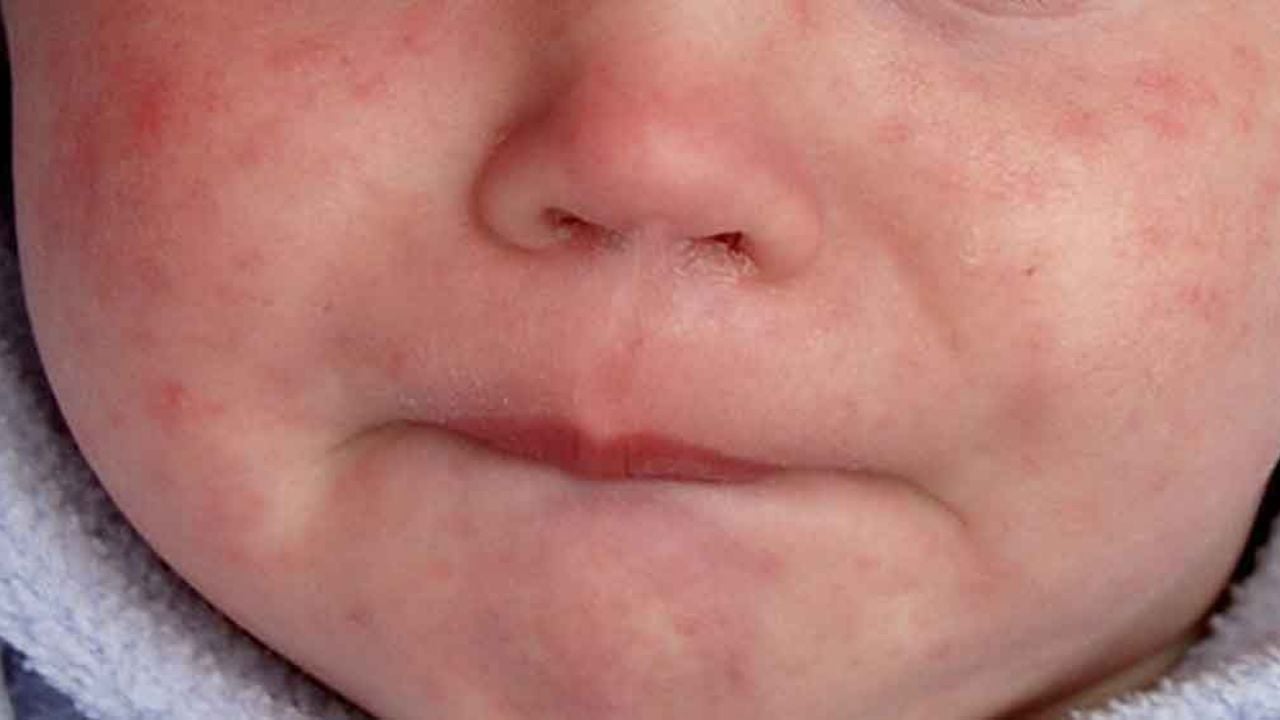 SSA activa alerta por la detección de un caso de sarampión en CDMX