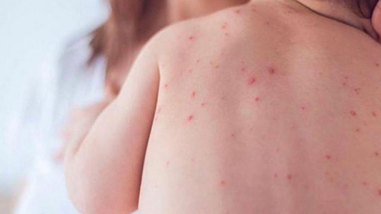 SSA confirma que son 4 casos de sarampión en CDMX, 2 niños y 2 adultos