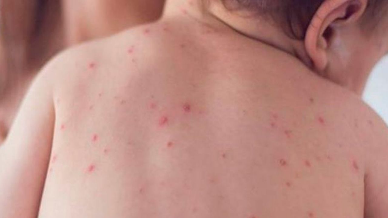 Niña sin vacunas se convierte en el primer caso de sarampión en Edomex