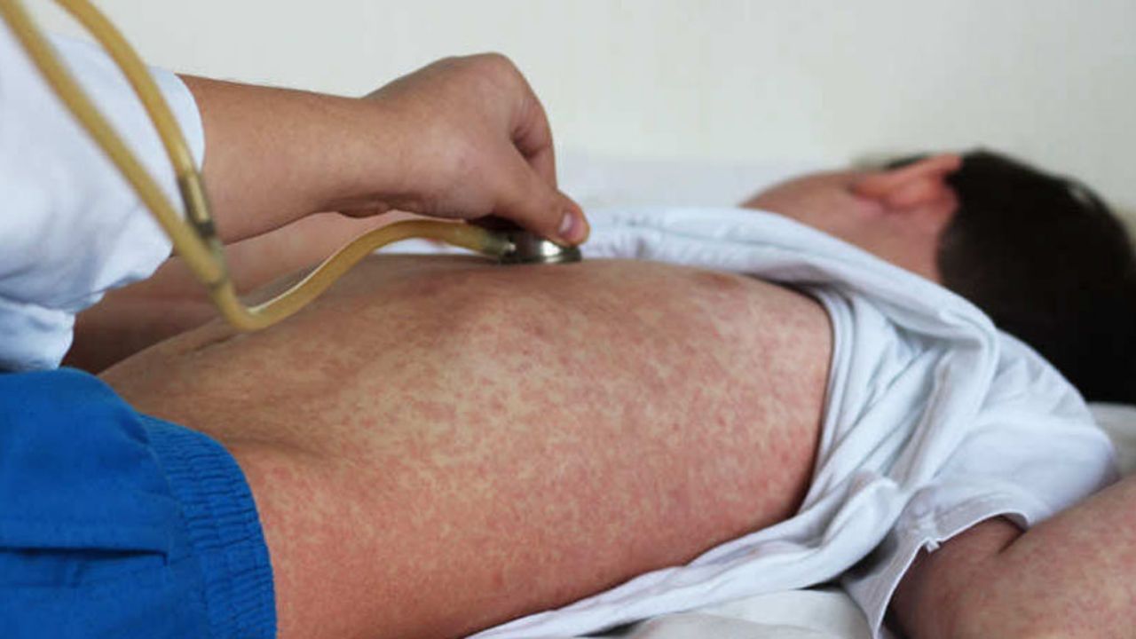 Van 49 casos de sarampión en México: En 20 años 201 contagios; 30 en 26 días