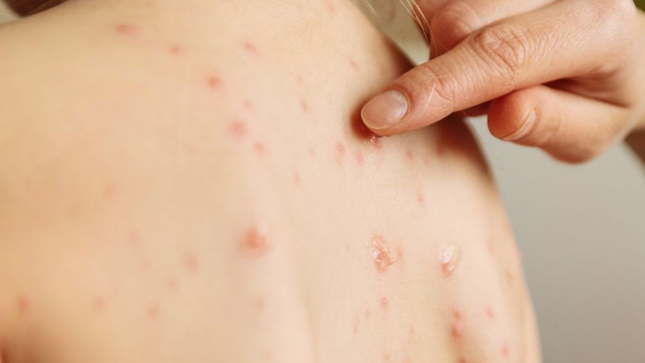 Secretaría de Salud informa que ya son 67 casos de Sarampión en la CDMX