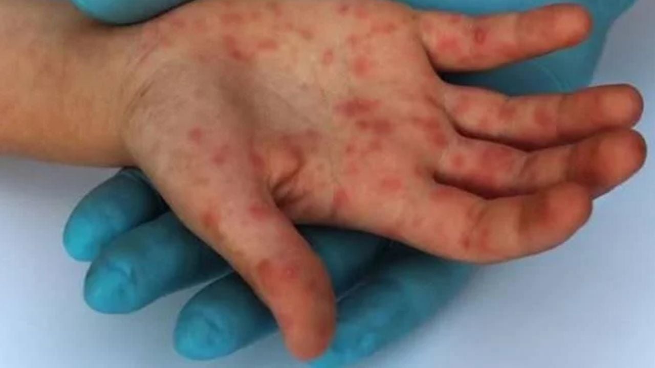 Casos de sarampión aumentan en la Ciudad de México; ahora son 69