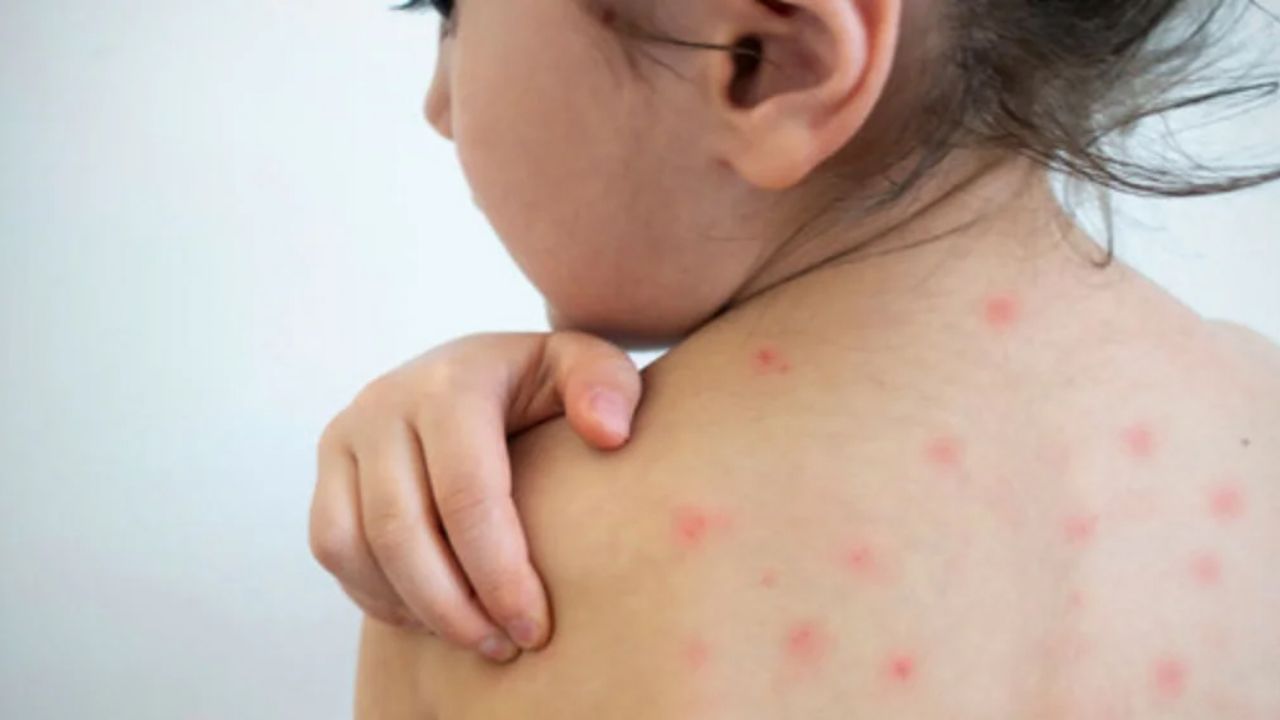 Cifra de casos de sarampión en el Valle de México aumenta a 73