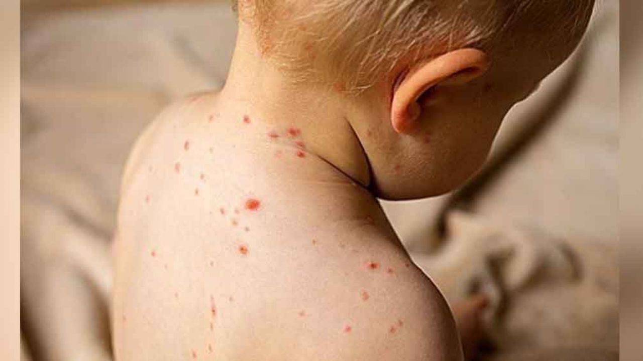 Cifra de casos de sarampión en México incrementa a 81, según SSA