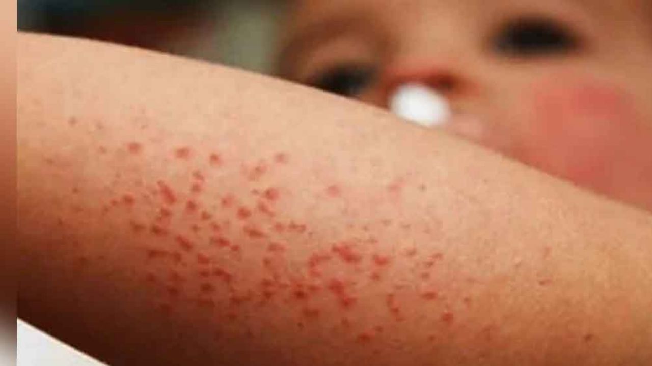 Casos de sarampión aumentan a 108 en México; hay uno nuevo en Campeche