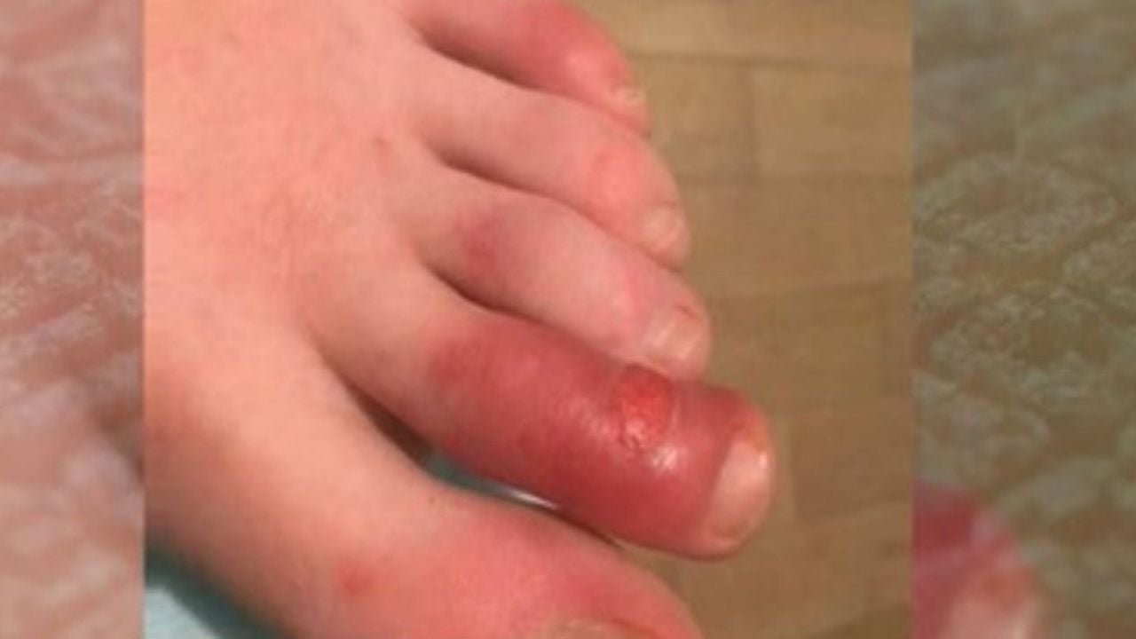 Dermatólogos detectan nuevo posible síntoma de coronavirus en niños