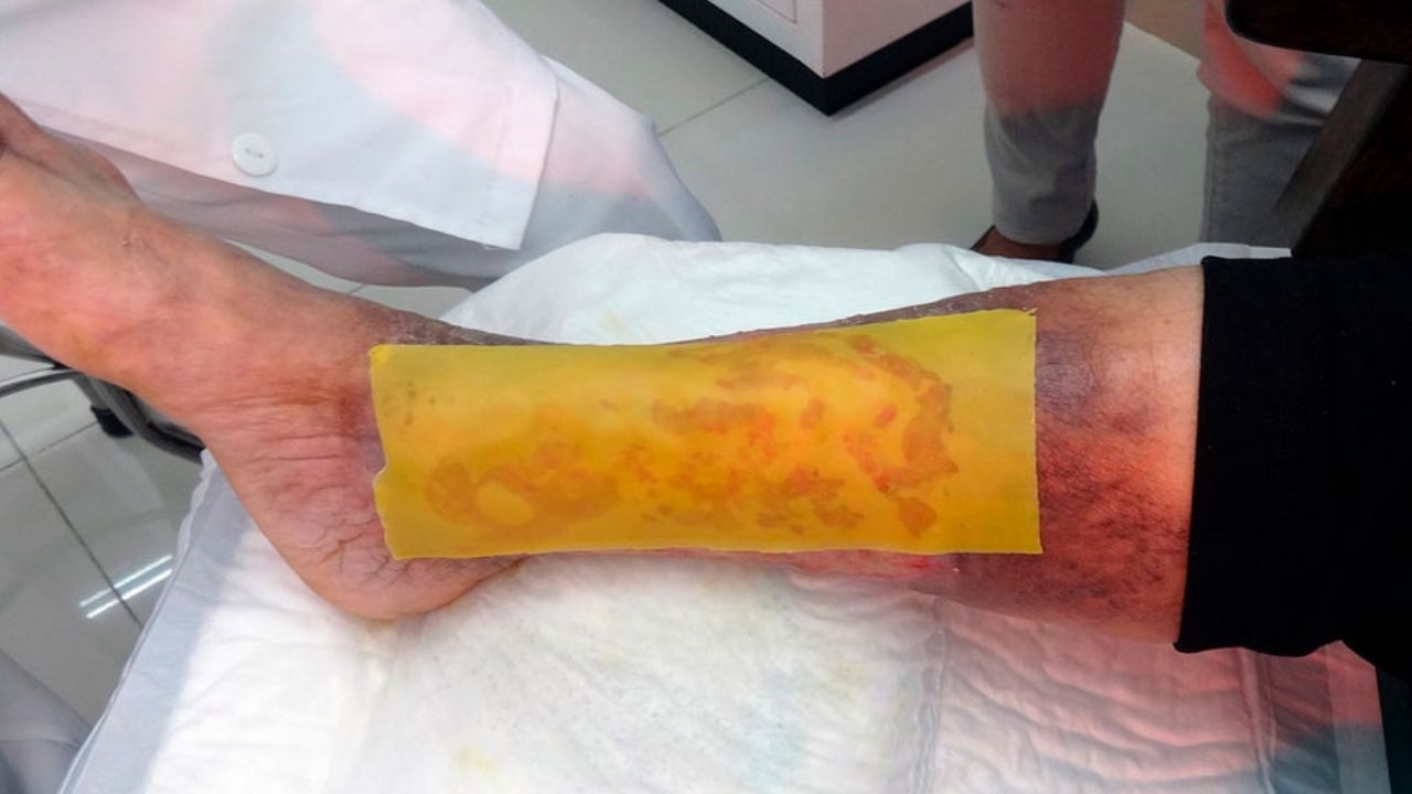 ¡Buenas noticias! Descubren parches que evitan la amputación del pie diabético