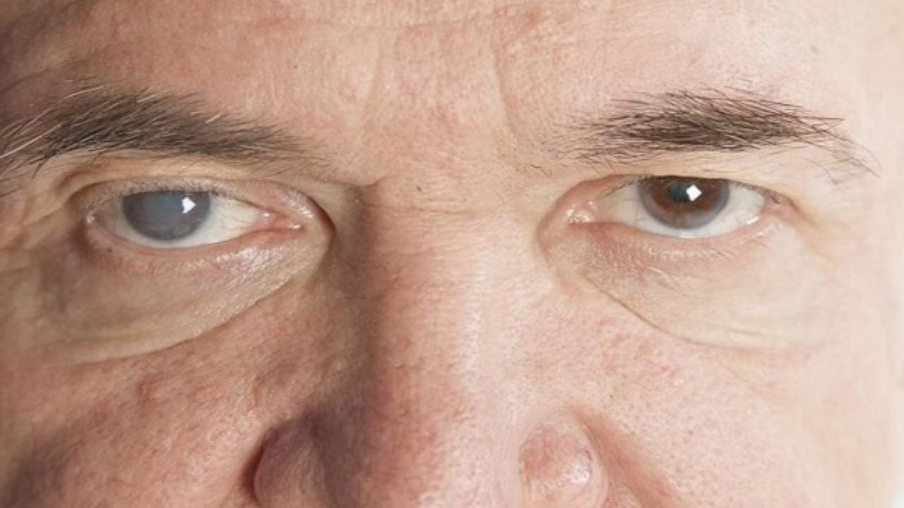 Glaucoma: ¿Qué es? claves para detectarla y prevenirla a tiempo