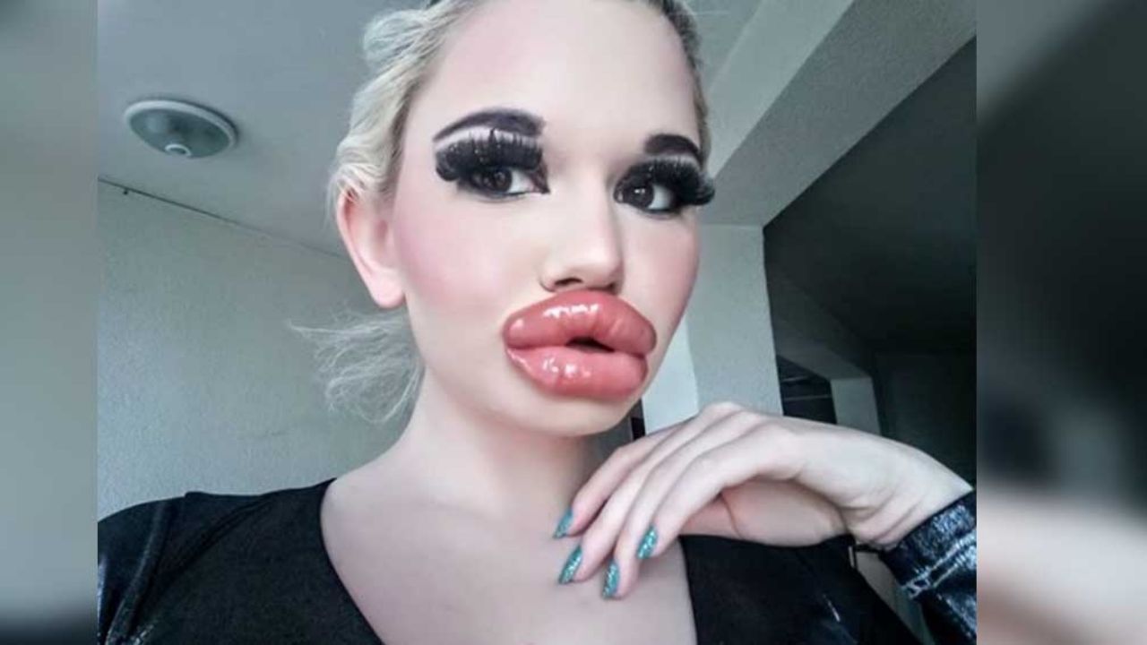 ‘Barbie humana’ se inyectará más relleno en los labios pese a que se le dificulta comer