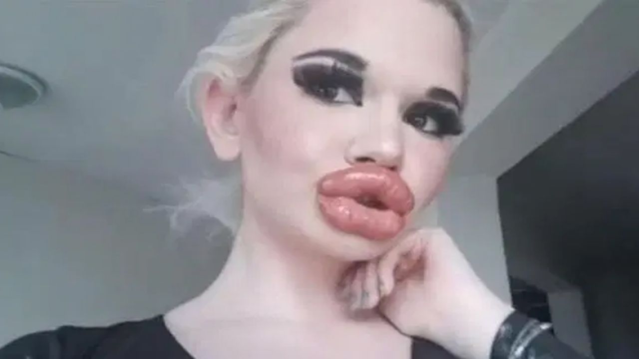 Andrea Ivanova, la ‘Barbie Humana’ obsesionada con cirugías que se deformó los labios
