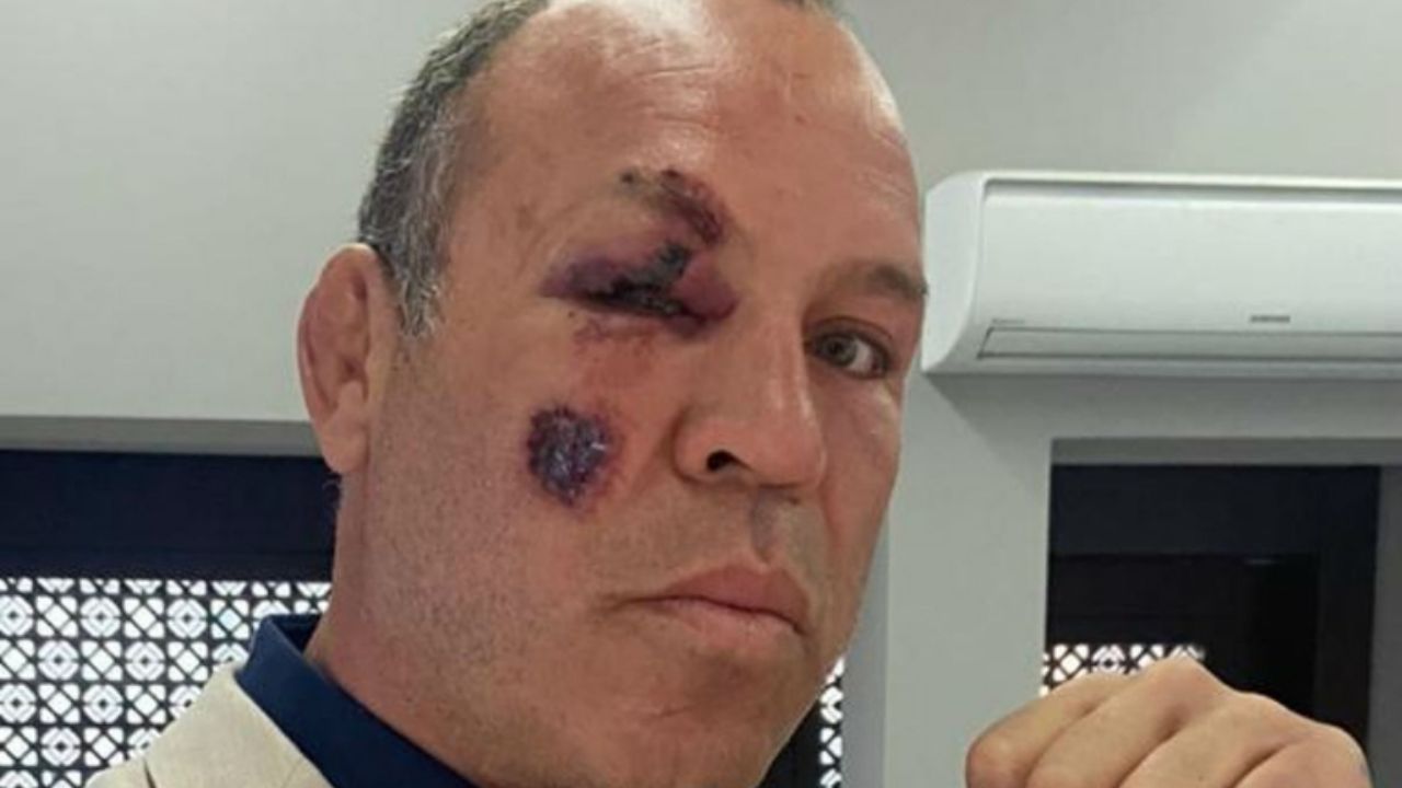 Exluchador de la UFC sufre accidente en Brasil; lo atropellan en su bicicleta