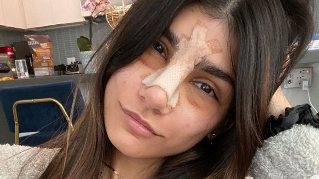 FOTOS: Mia Khalifa se quita los vendajes y presume su nueva nariz en Instagram