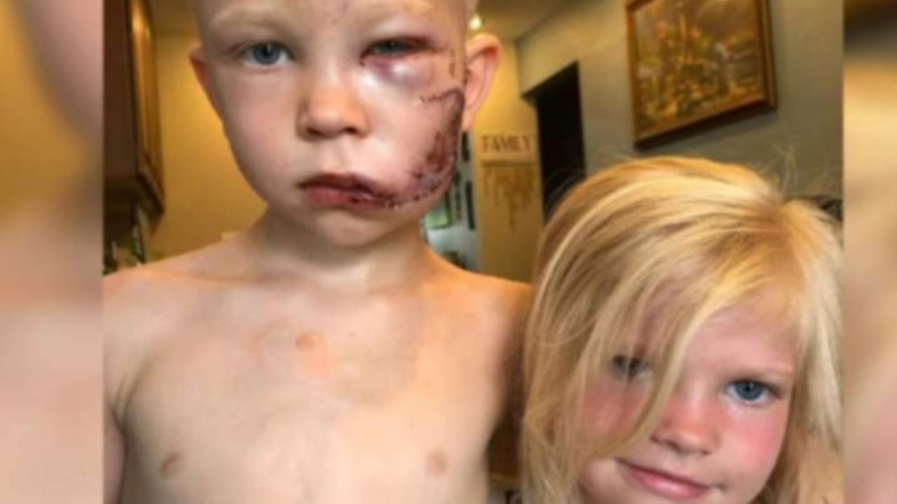 Pequeño de 6 años recibe feroz ataque de un perro por defender a su hermana