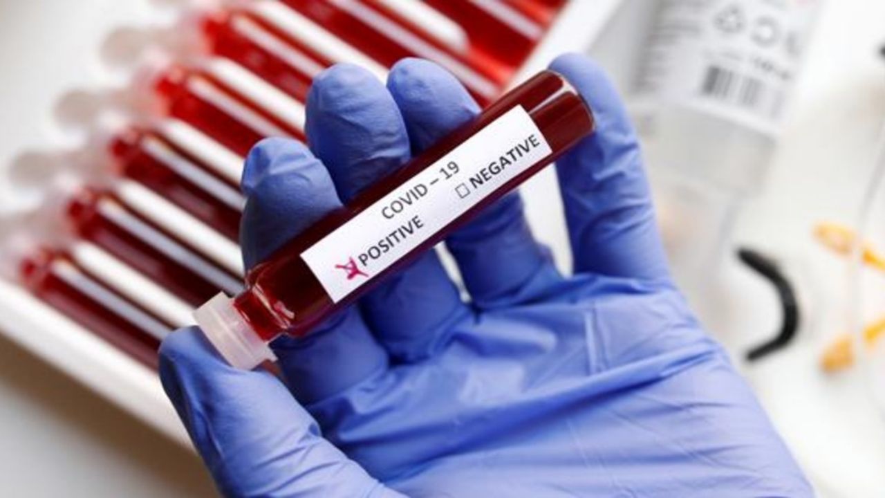 Coronavirus: El mundo ya registra más de 15 millones de casos positivos