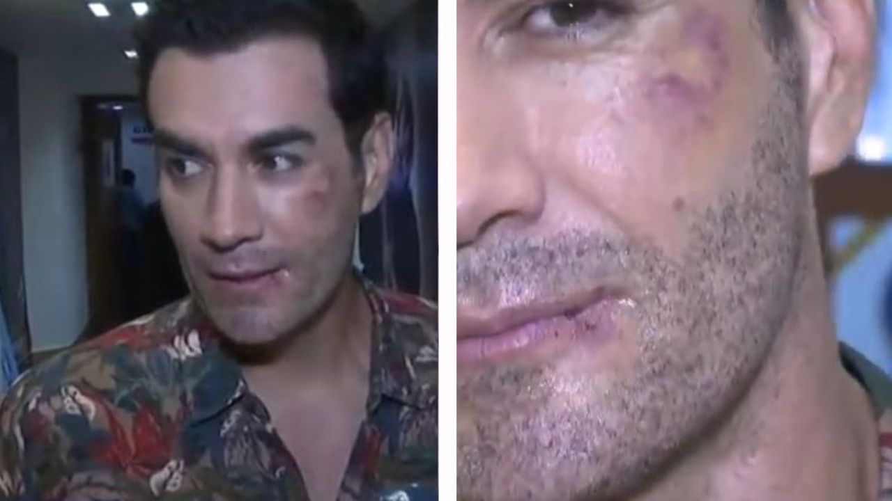 VIDEO: Querido galán de Televisa aparece en ‘Hoy’ totalmente ‘golpeado’