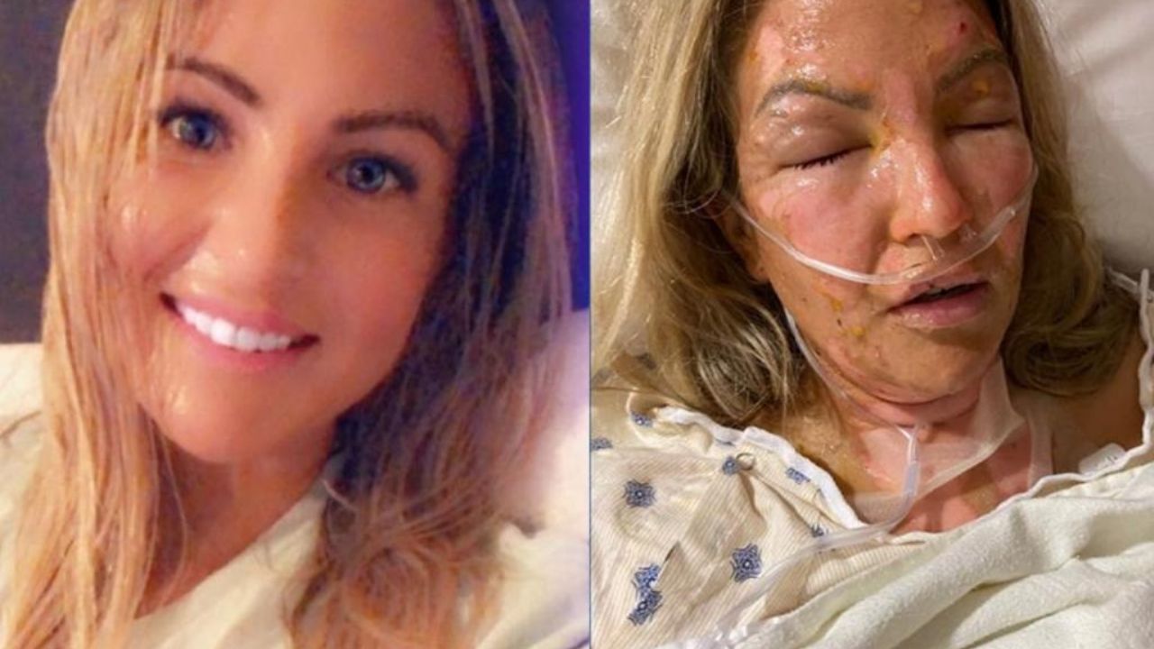 Tras usar gel antibacterial, mujer prende una vele y arde en llamas en EU