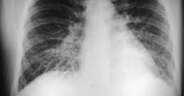 Pulmones afectados por el hantaviru.
