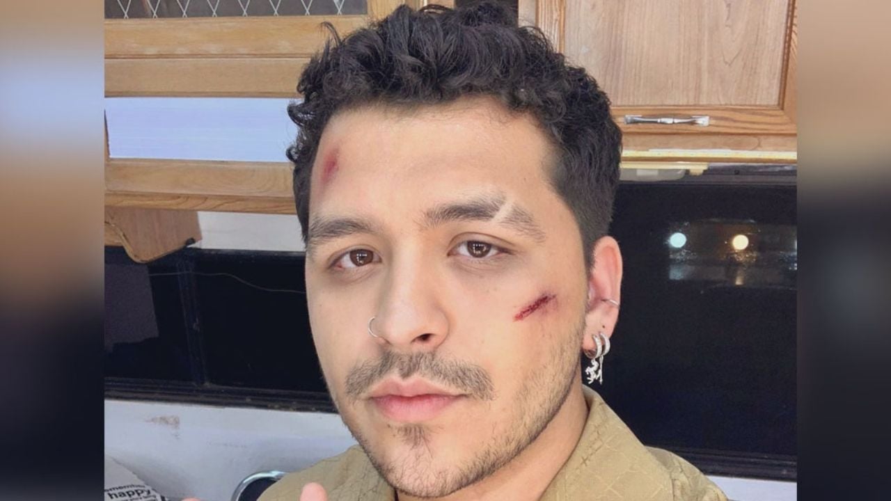 ¡Los golpes siguen! Christian Nodal revela que ‘duele’ tener heridas en el rostro y corazón