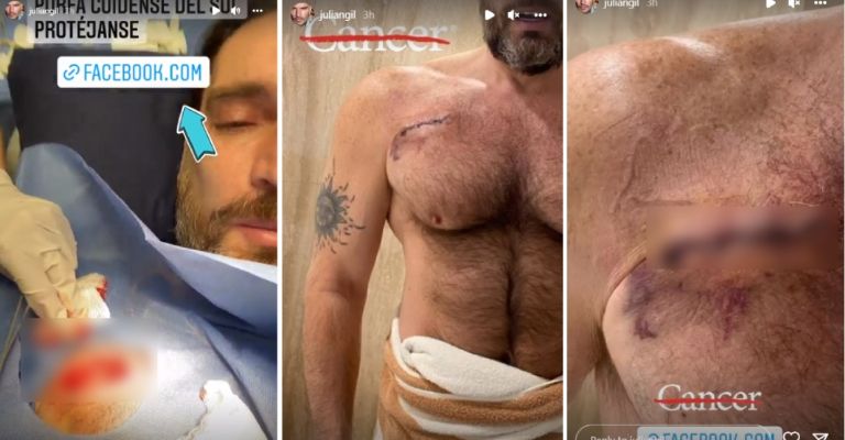 Julián Gil revela que padece cáncer de piel nuevamente