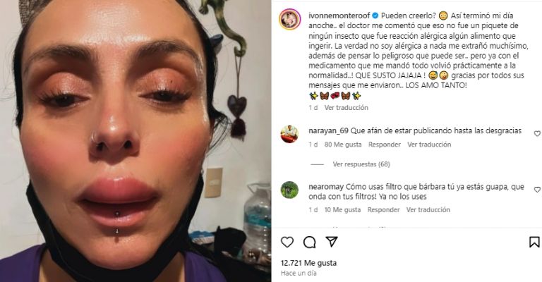 El diagnóstico médico de la hinchazón fue reacción alérgica a algún alimento