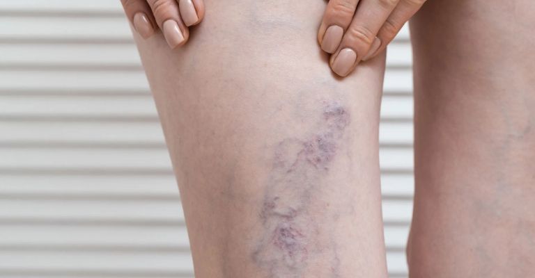 La trombosis sería posible sólo en casos raros, según Astrazeneca