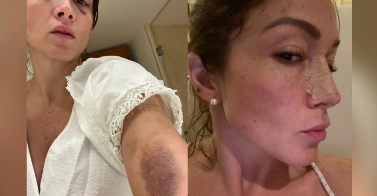 Laura Vignatti exhibe fotos de la brutal golpiza que recibió y denuncia a su novio