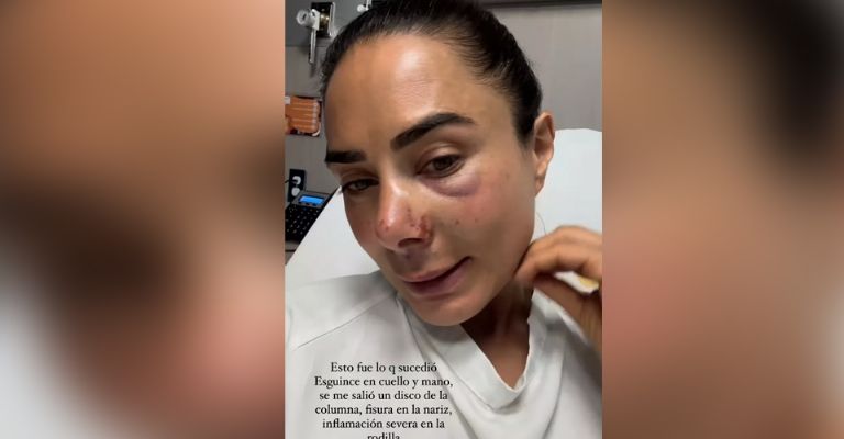 Johanna Fadul sufre terrible accidente en Los 50 y podría quedar paralizada
