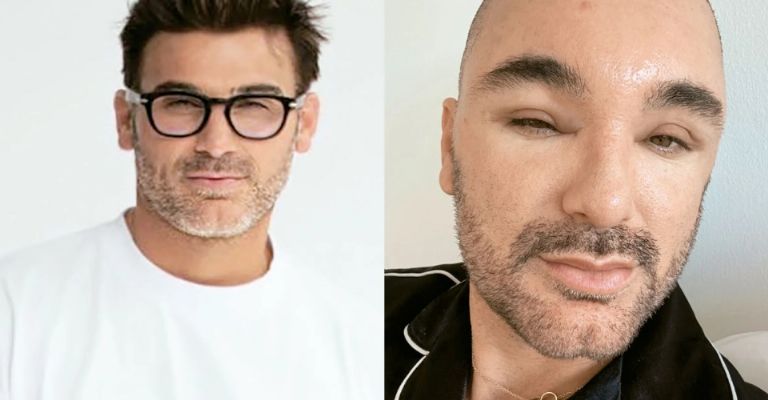 Mauricio Mejía confiesa que se le deformó el rostro tras arreglo estético