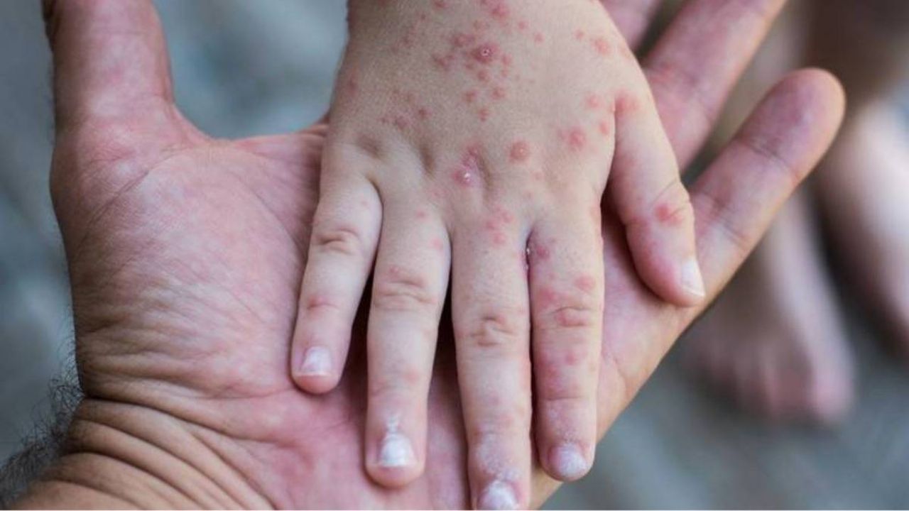 Sarampión en México: Estos son los síntomas de alerta; aumentan los casos