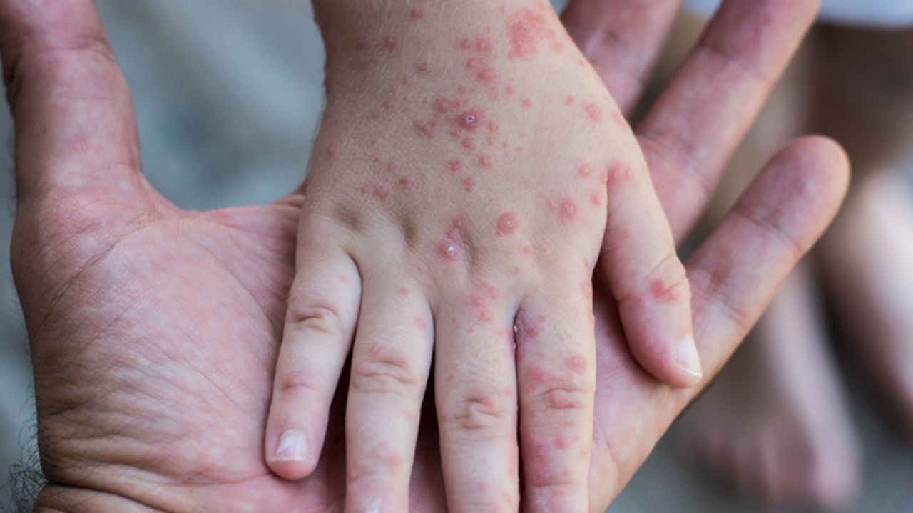 Salud Sonora confirma 4 casos importados de sarampión en Cajeme; contagios son de Chihuahua