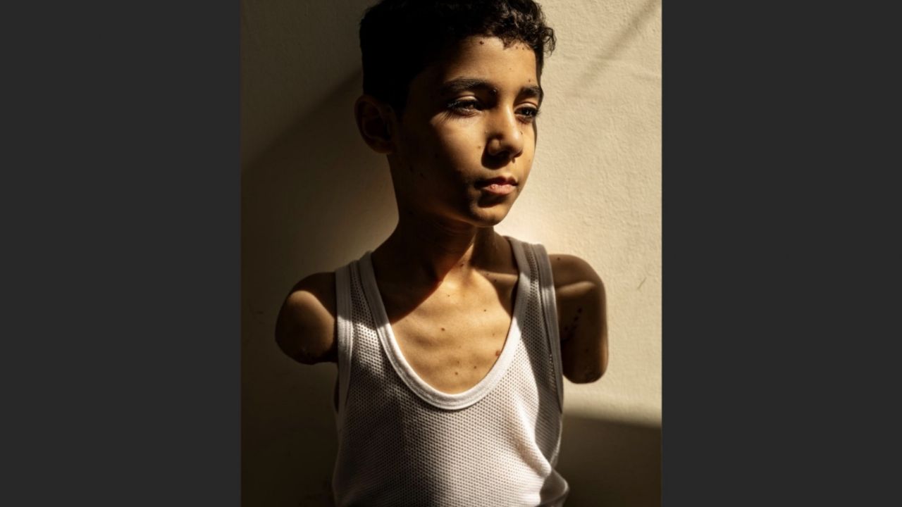 Niño de Palestina sin brazos: La impactante FOTO ganadora del World Press Photo 2025