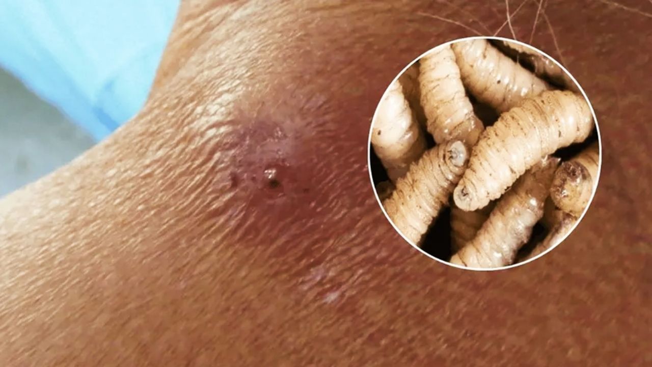 Alerta en México: Confirman primer caso de miasis por gusano barrenador en humanos