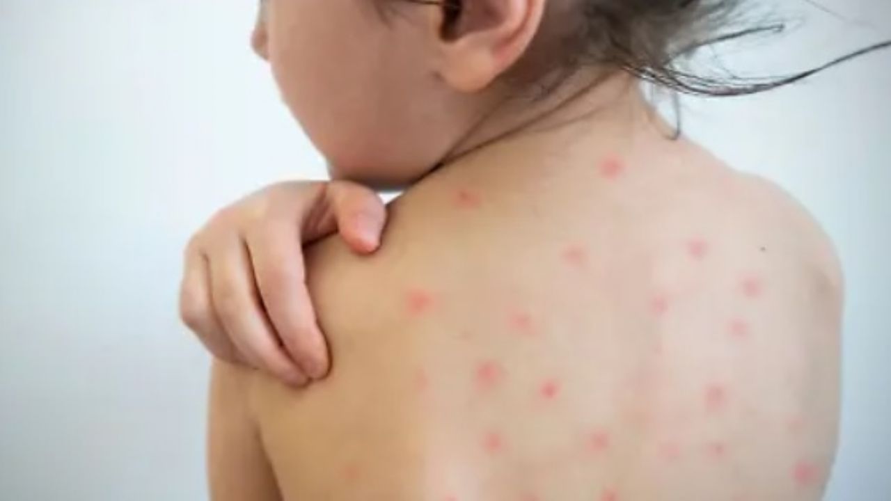 Navojoa en ‘focos amarillos’ por casos sospechosos de sarampión