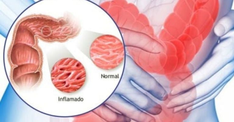 Los síntomas comunes del SII, dolor abdominal, gases, diarrea, estreñimiento