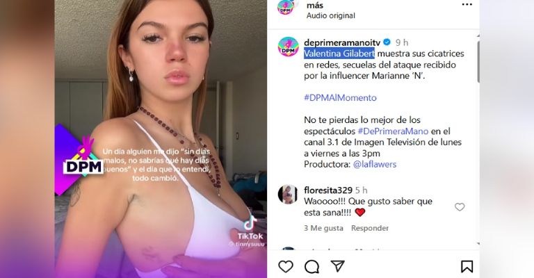 Valentina Gilabert exhibe las cicatrices que le dejó Marianne Gonzaga tras su brutal ataque de 13 puñaladas