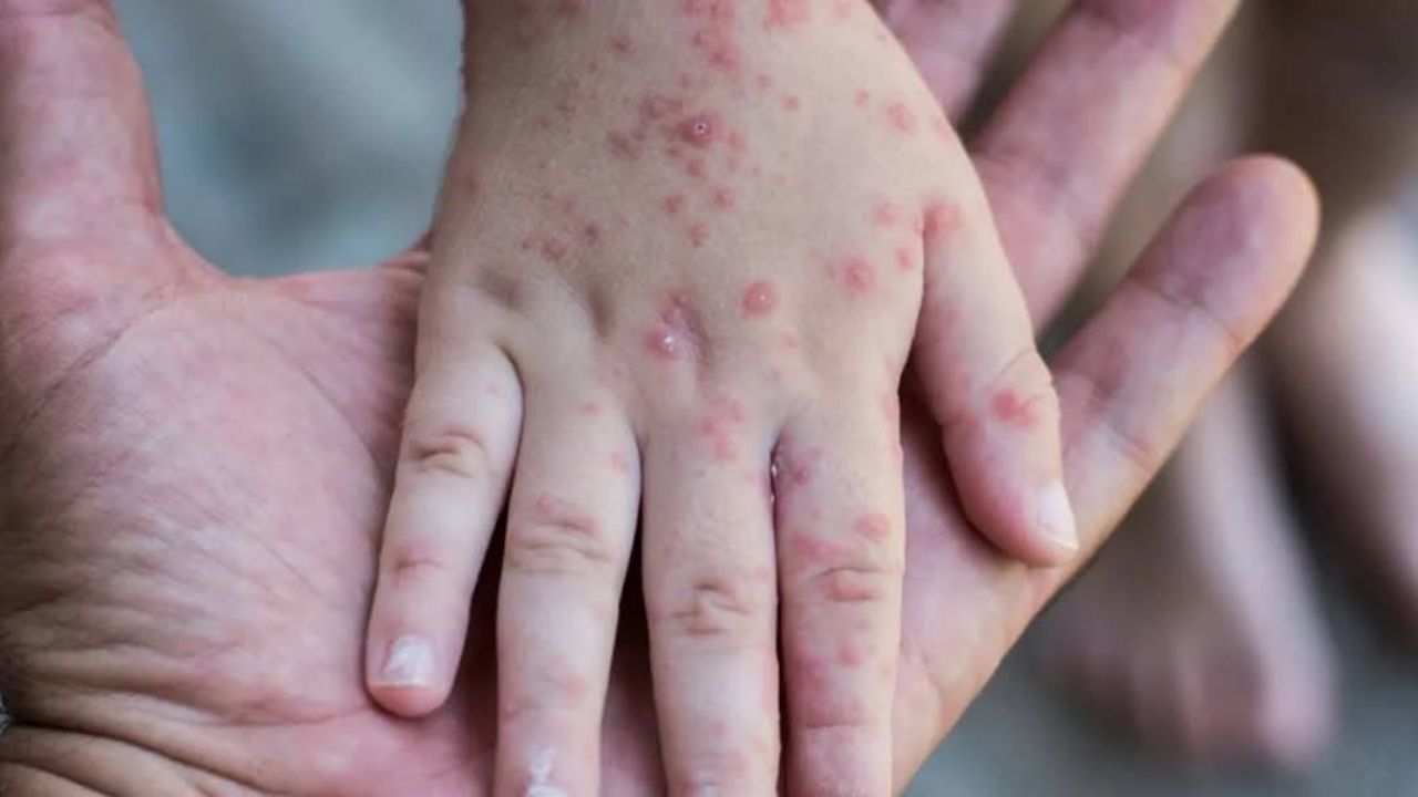 Brote de sarampión en México: Suman 12 muertes registradas por esta enfermedad