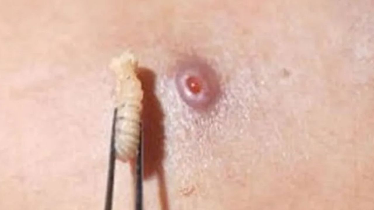 Suman cuatro casos de miasis por gusano barrenador en residentes de ejido Altamira Chiapas