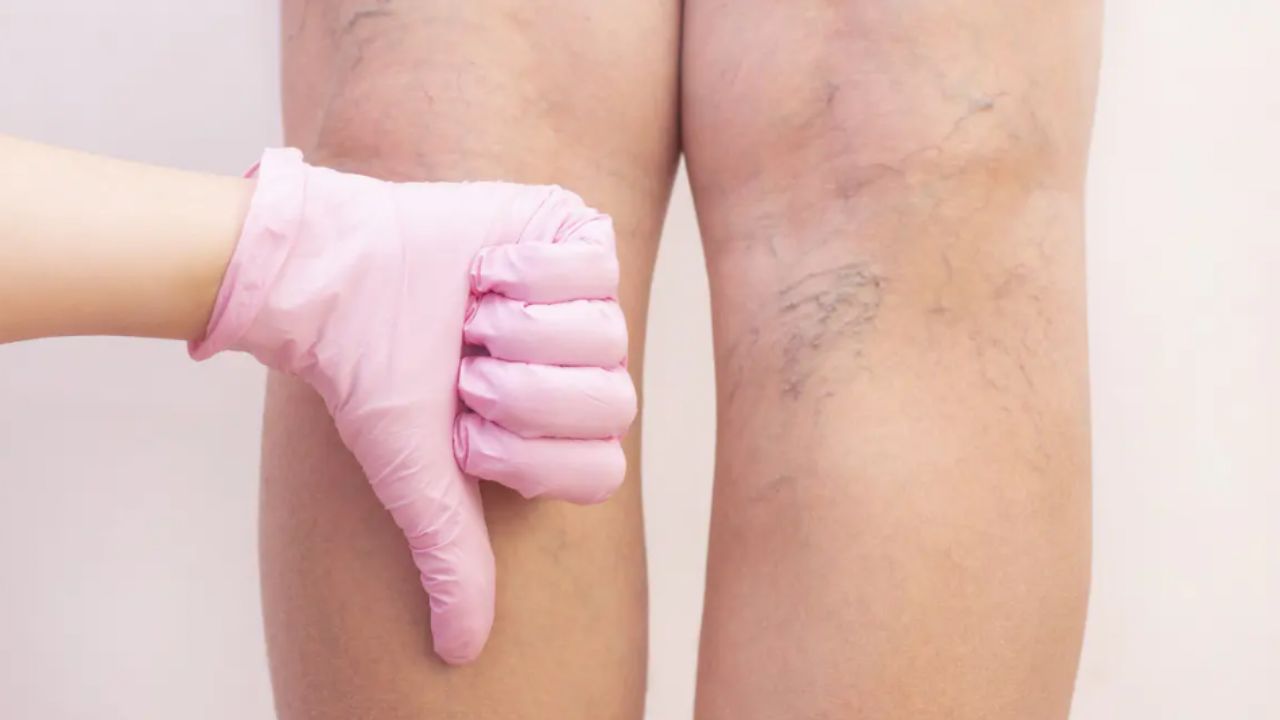 ¿Problemas de varices? Estas 3 vitaminas para piernas y ‘chamorros’ son la solución