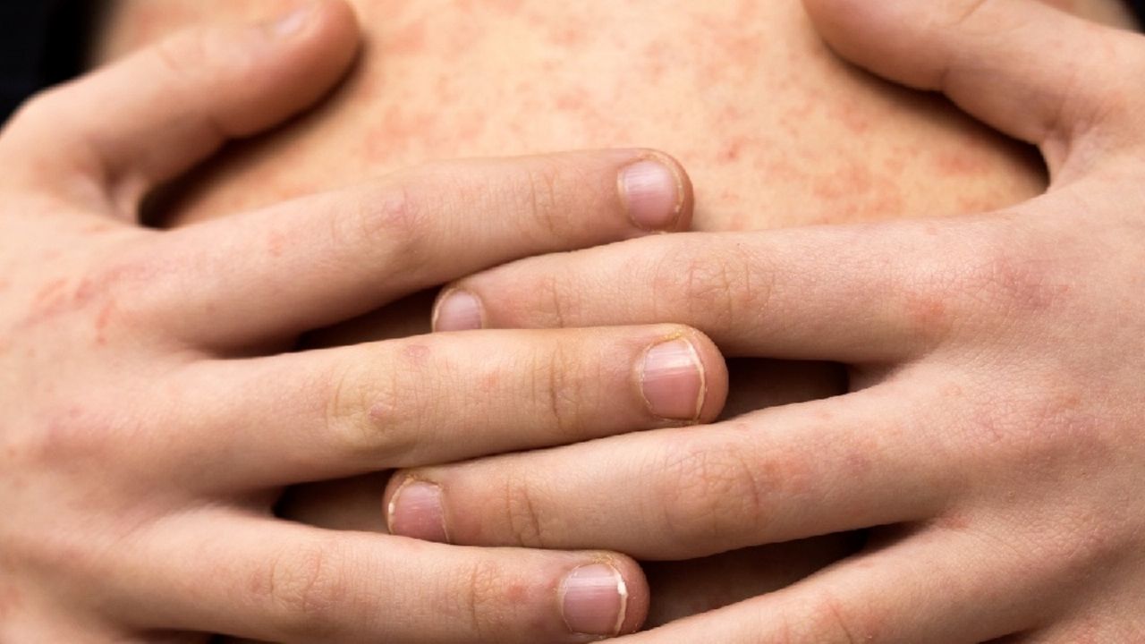 México se ubica en segundo lugar por muertes de sarampión en América después de Canadá