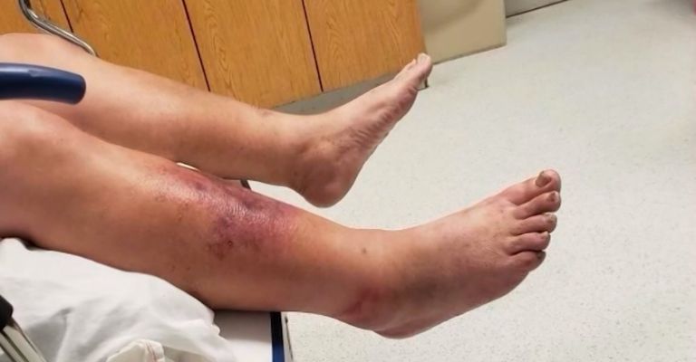 Suben a 30 los infectados por bacteria marina en EU