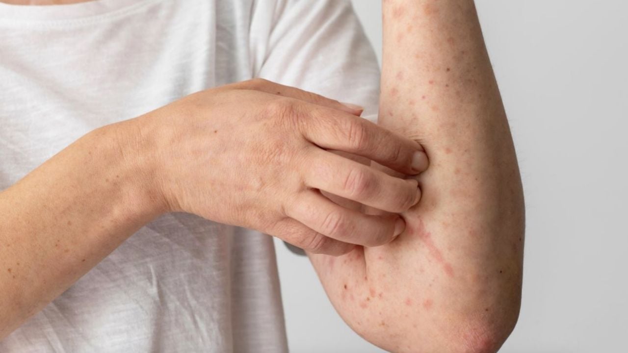 Confirman 17 muertes por sarampión en México; Sonora, segunda entidad con más contagios