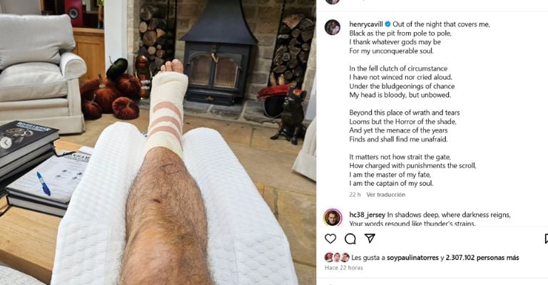 Henry Cavill comparte foto de su terrible lesión tras accidente al entrenar