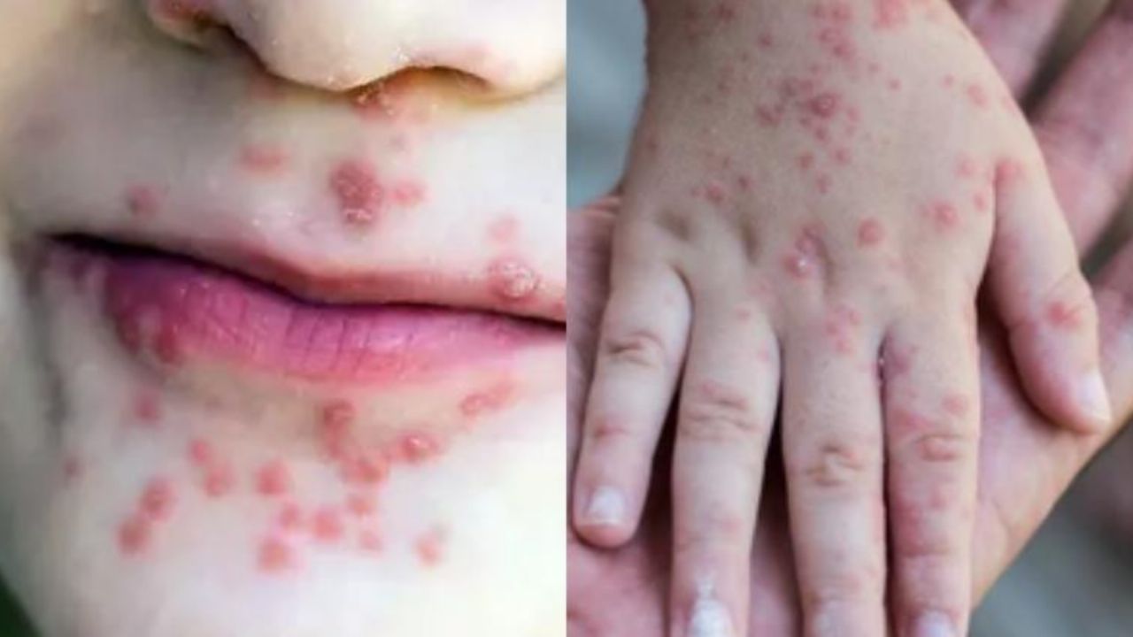 ALERTA: Brote de virus coxsackie; se suspenden clases en varios estados de México