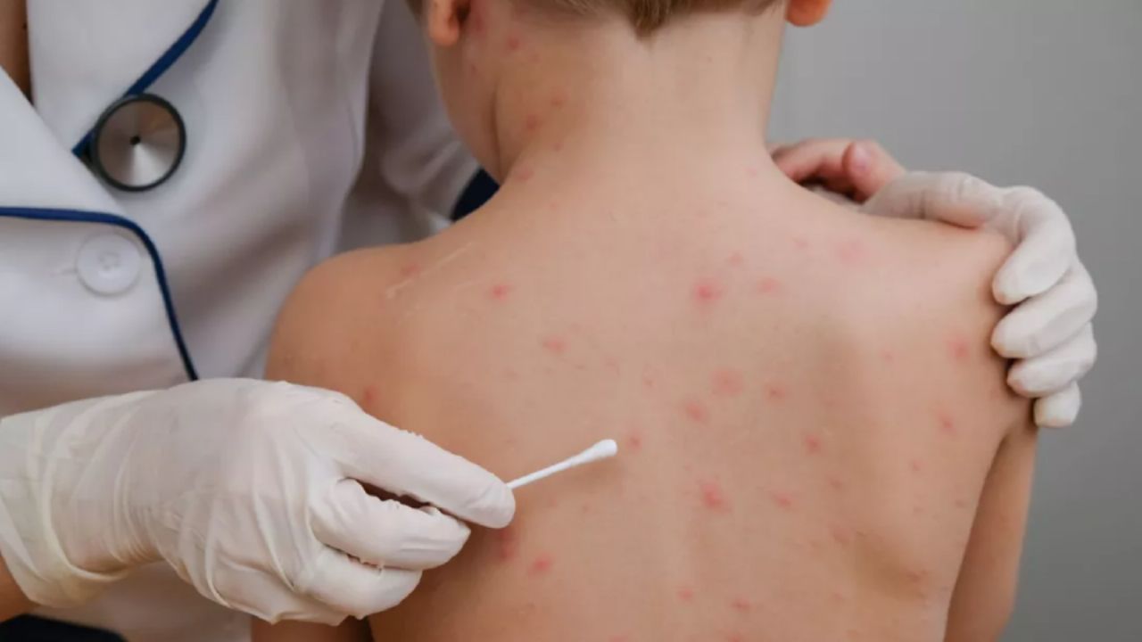 México enfrenta 23 muertes por sarampión pese al reciente descenso en la curva de contagios